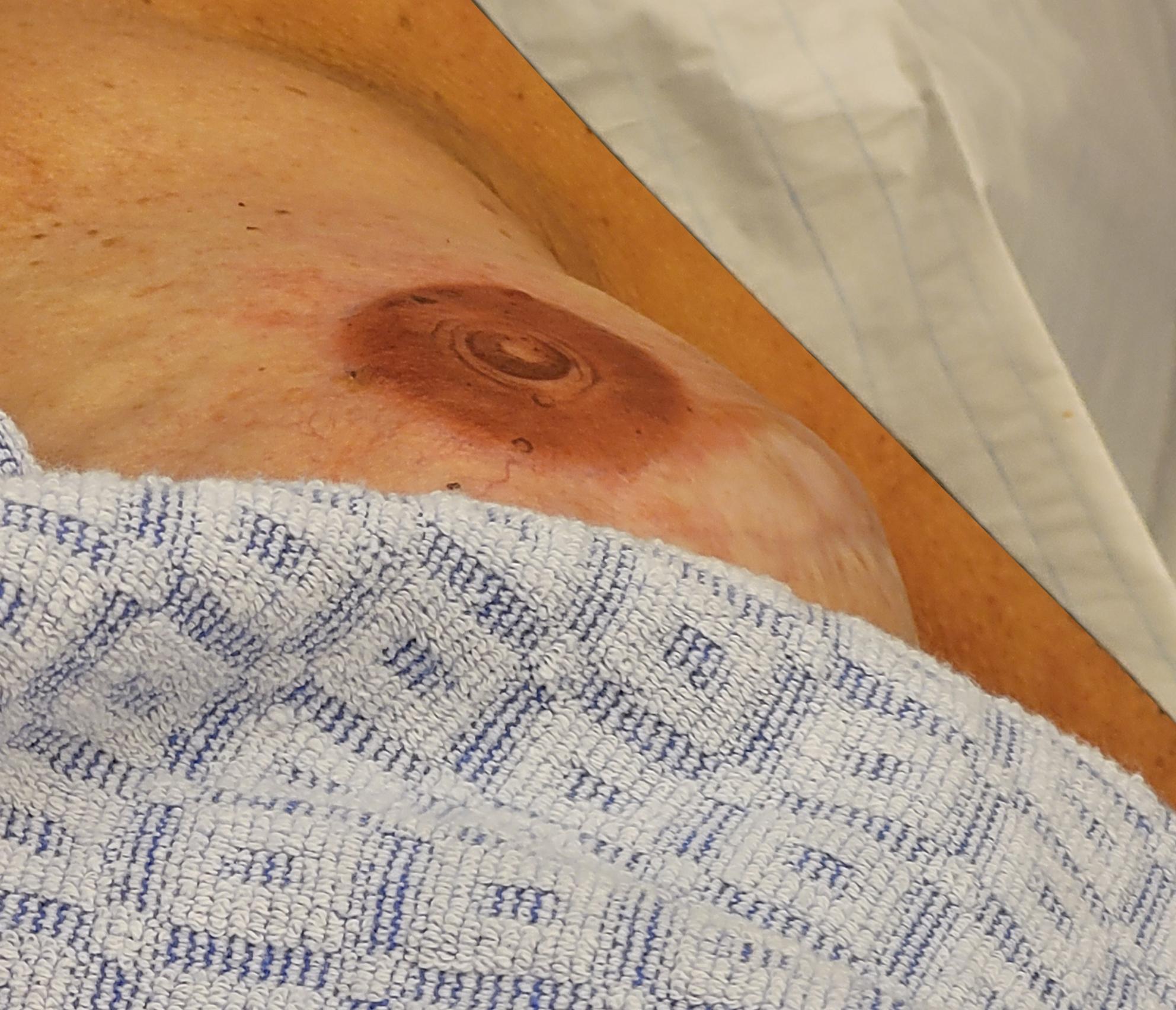 dermatografie tepeltattoo