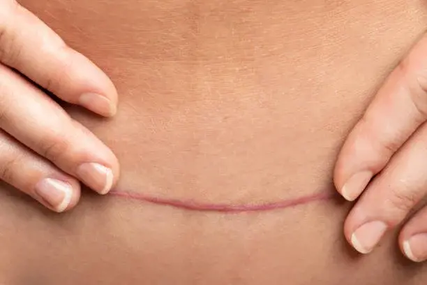 Dermatografie