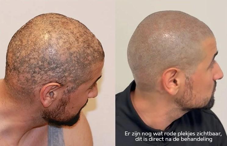 alopecia voor en na mhp behandeling 1