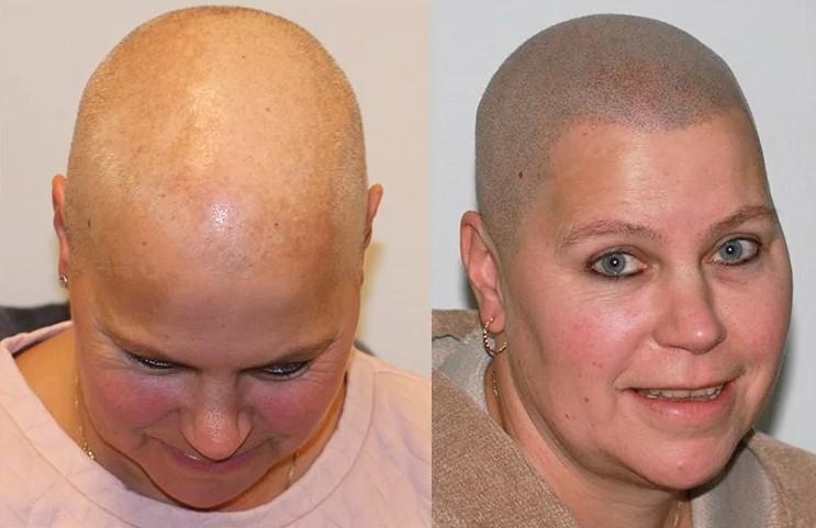 alopecia voor en na MHP behandeling 2