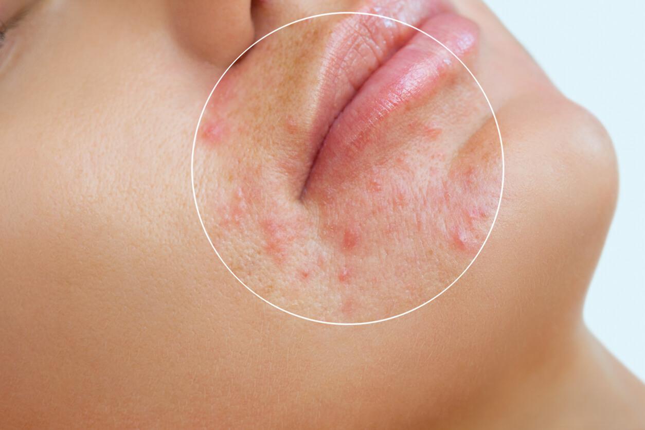 (Actieve) acne