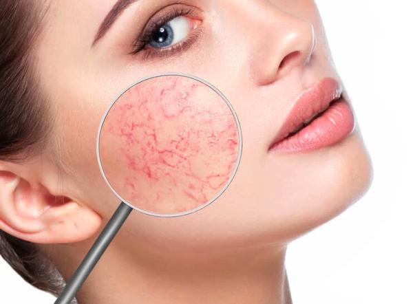 Adertjes, couperose, roodheid