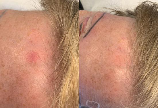 couperose behandeling