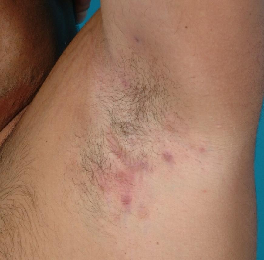 Behandeling acné, littekens verwijderen en hidradenitis suppurativa