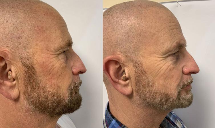 Pigmentvlekken Verwijderen resultaat