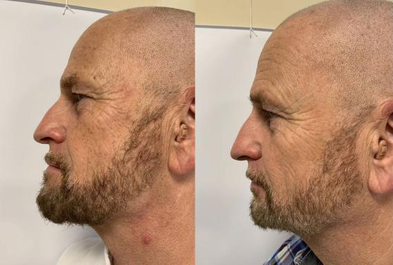 Pigmentvlekken Verwijderen resultaat