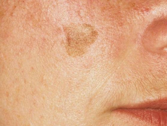 Pigmentvlekken verwijderen