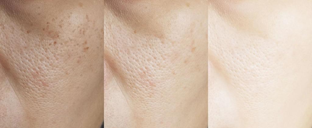 Pigmentvlekken verwijderen resultaat