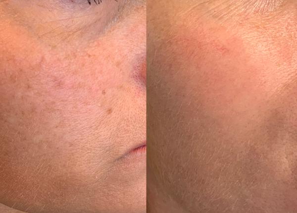 Pigmentvlekken Verwijderen resultaat