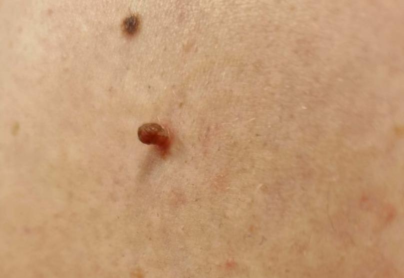 Fibromen, Wratjes, Dermatosis Papulosa