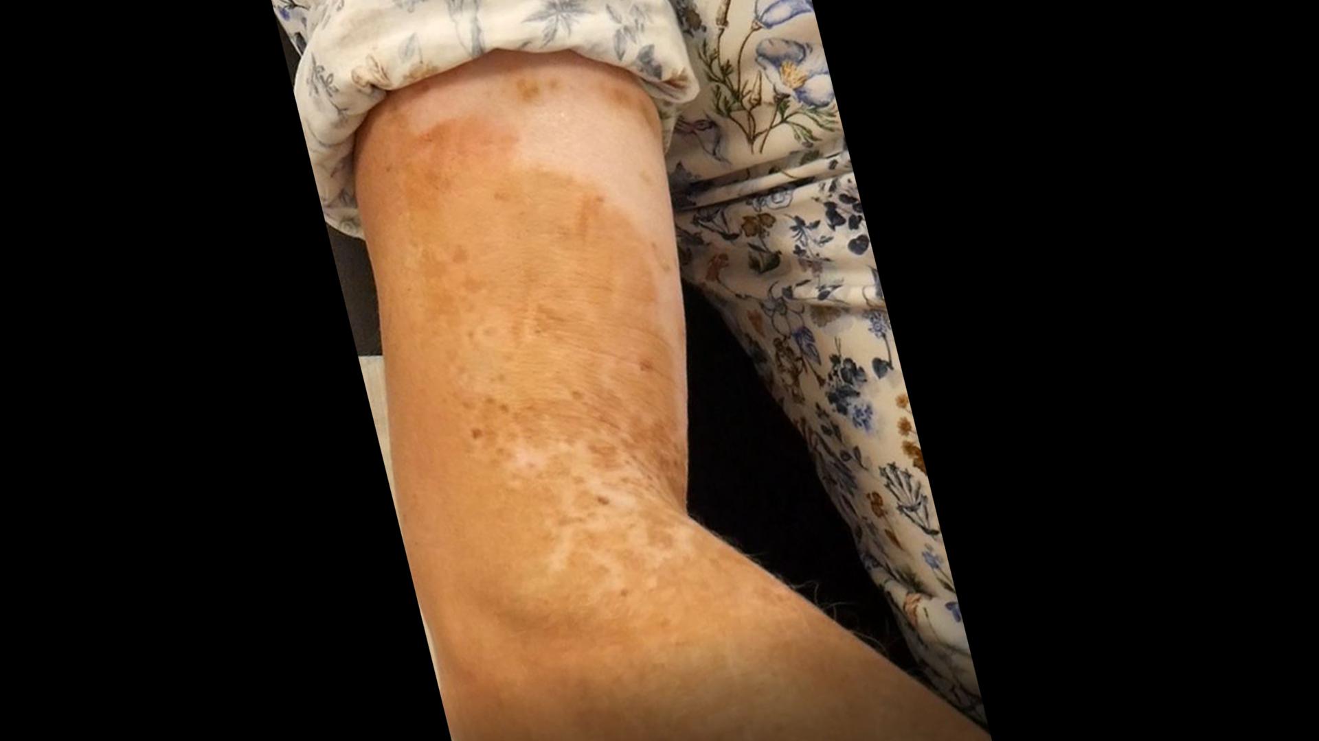 De kosten van een medische tatoeage