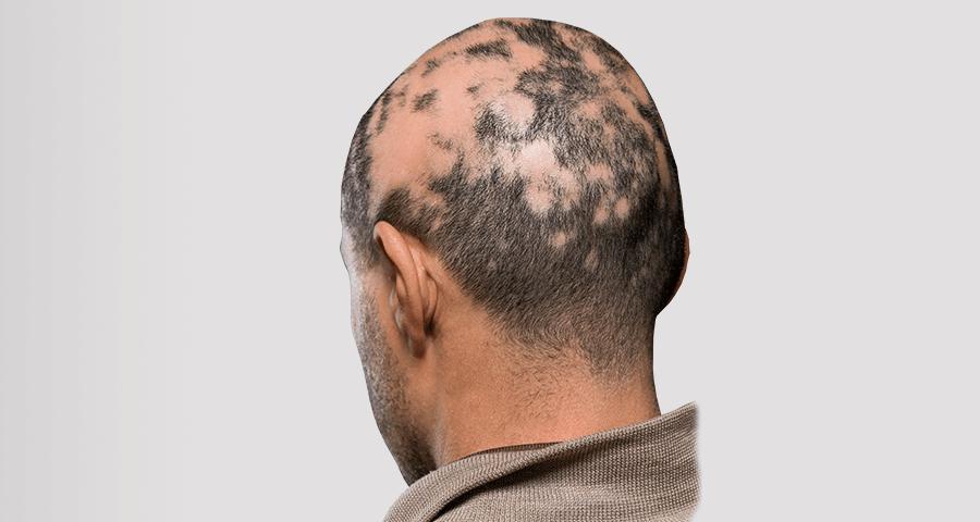 Wat is een medische tattoo?