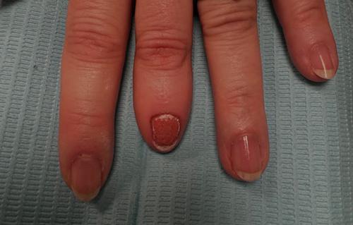 Nagelpigmentatie