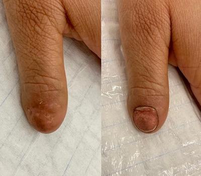 Nagelpigmentatie