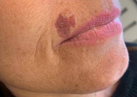 Een wijnvlek naevus flammeus behandeling verwijderen met medische tattoo