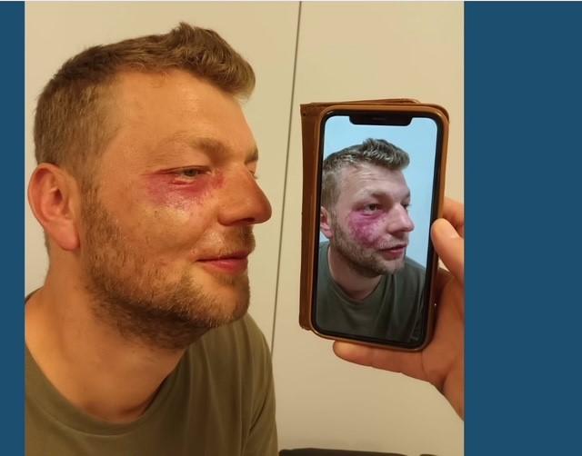 Wijnvlek behandeling