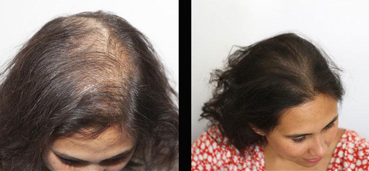 MHP Micro Haar Pigmentatie bij dun haar voor vrouwen