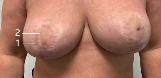 Tepel tattoo na borstverkleining op borstlift