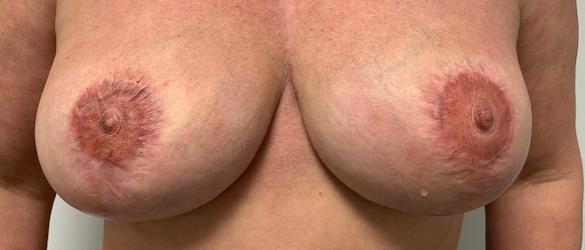 Medische tatoeage bij asymmetrische tepels