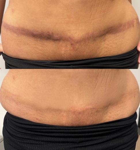 buikwand correctie tattoo