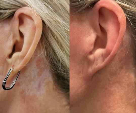 Littekens camoufleren bij TB medical