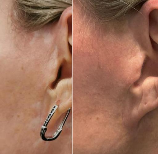 Littekens na facelift camoufleren