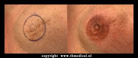 borstkanker tattoo tepel tattoo ziekenhuis huidtherapeut