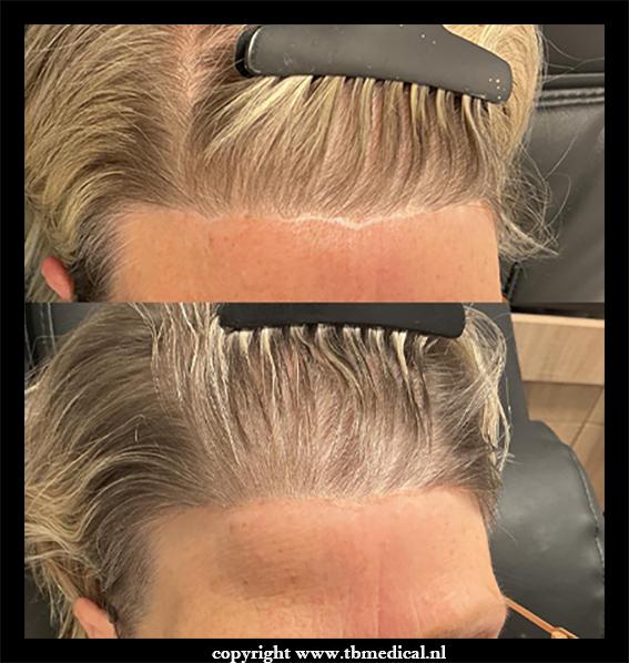 Facelift littekens 