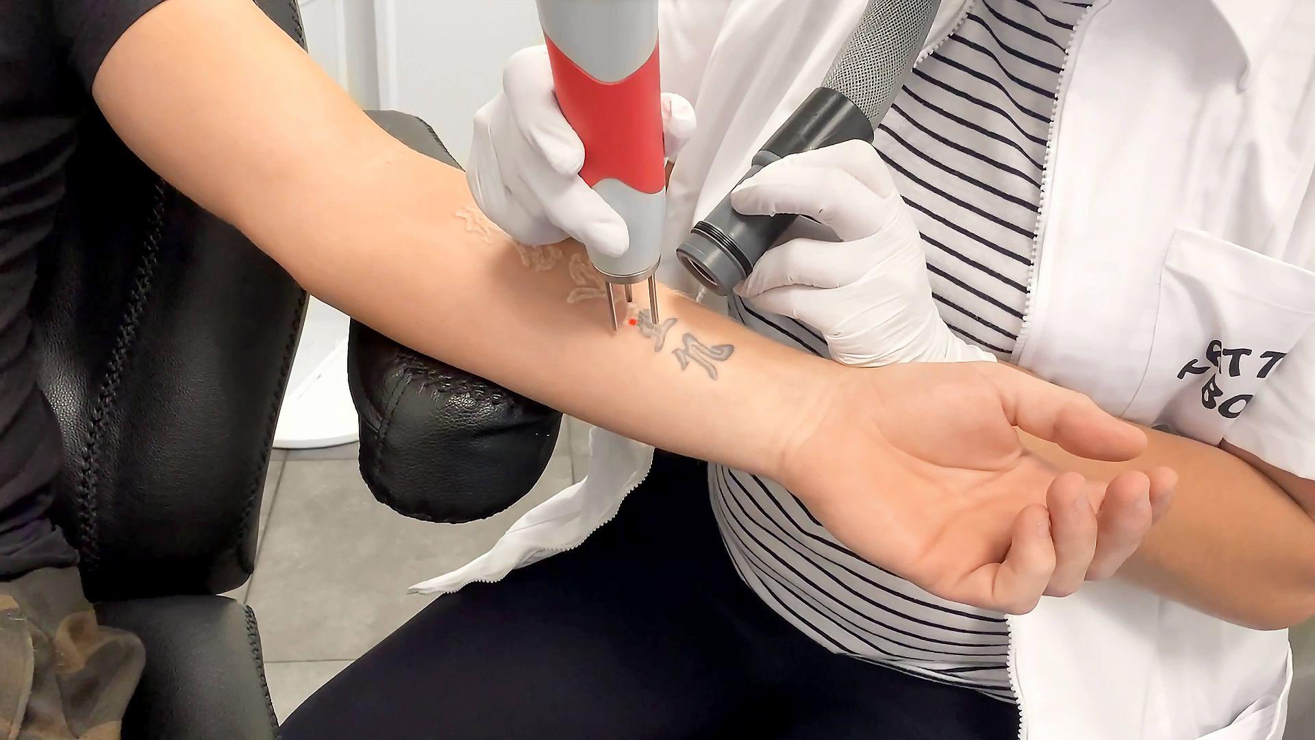 Tattoo verwijderen