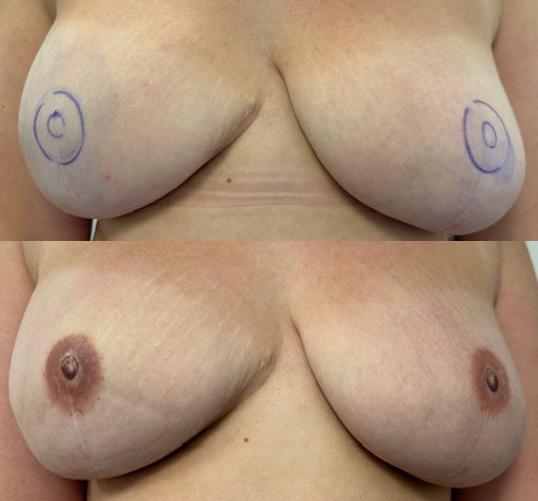 tepelttattoo