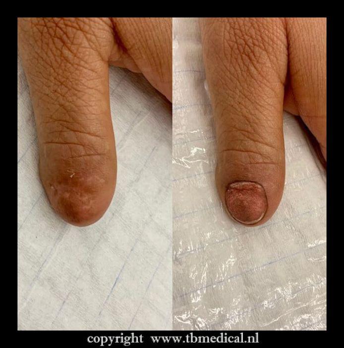 Nagel tattoo bij TB Medical