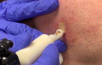 wijnvlek in het gezicht